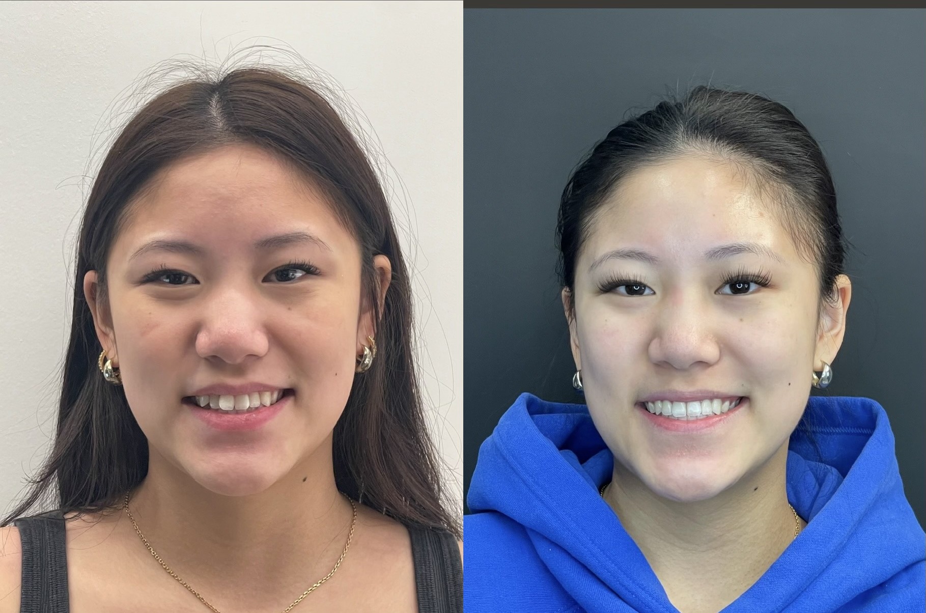 Before and after smile photos of a real Invisalign patient at Cityview Dental