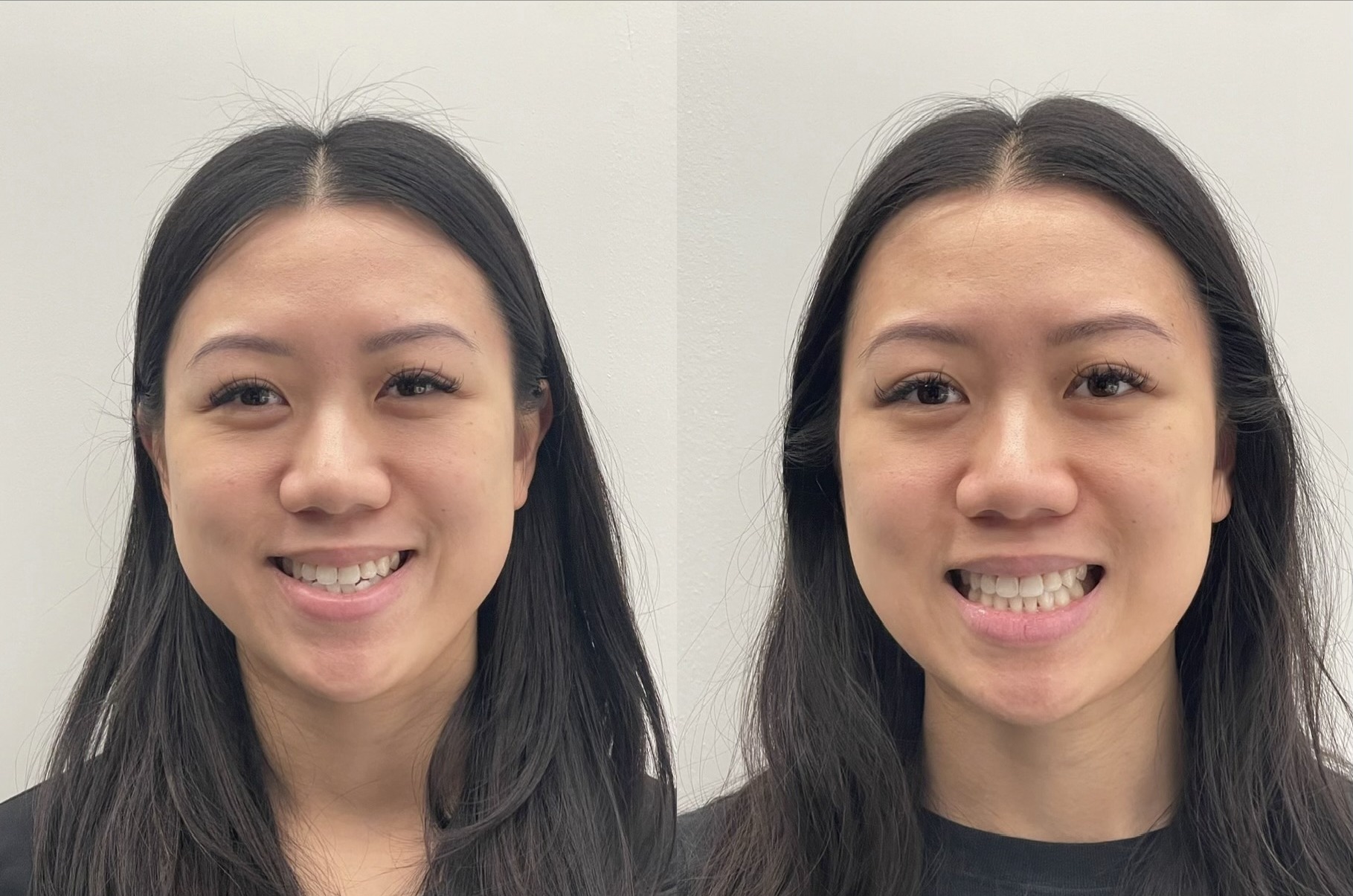 Before and after smile photos of a real Invisalign patient at Cityview Dental